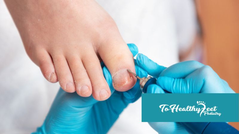 Ingrown Toenail Treatment – My FootDr