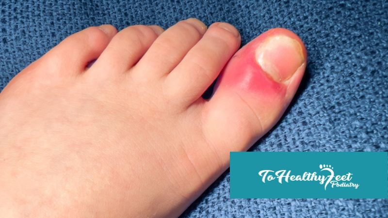 Ingrown Toenails in Fort Myers & Cape Coral, FL | Peter B. Walimire, DPM