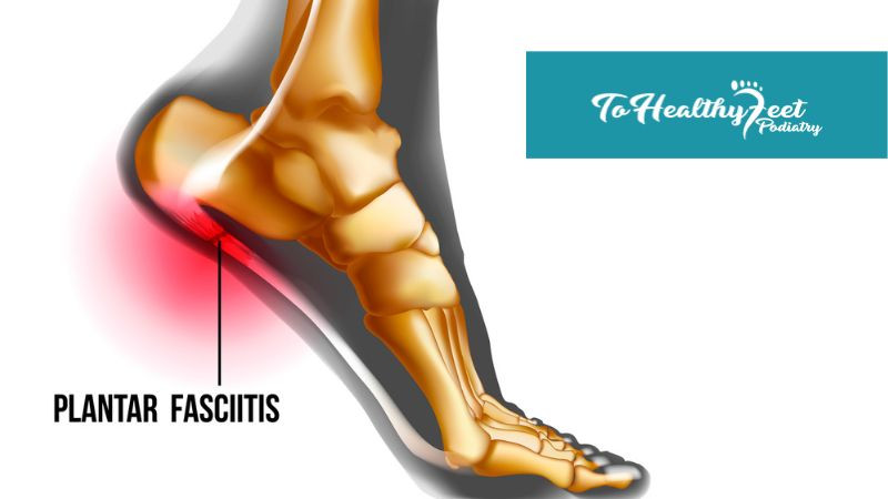 Plantar fasciitis vs. gout: Similarities and differences