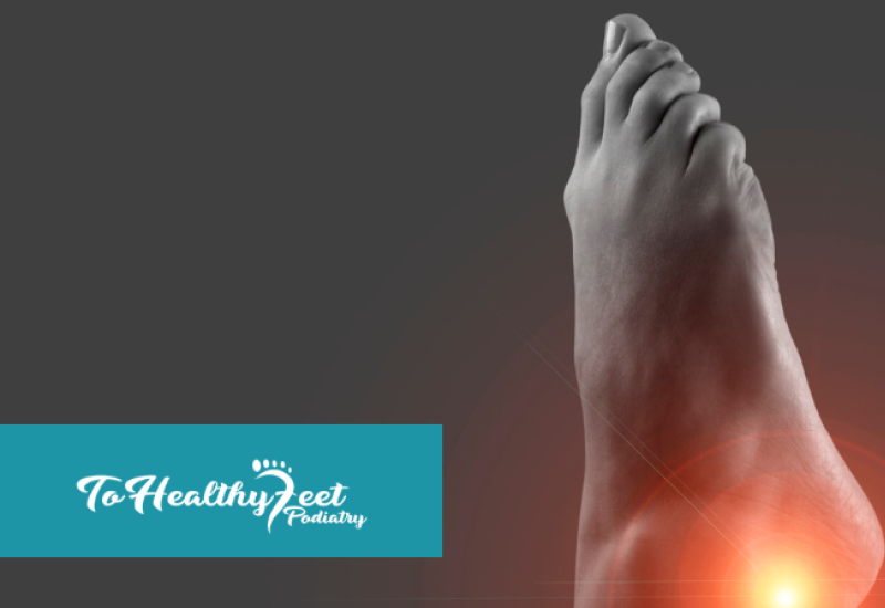 What Is Tarsal Tunnel Syndrome? An NYC Guide to Nerve Compression in the Foot