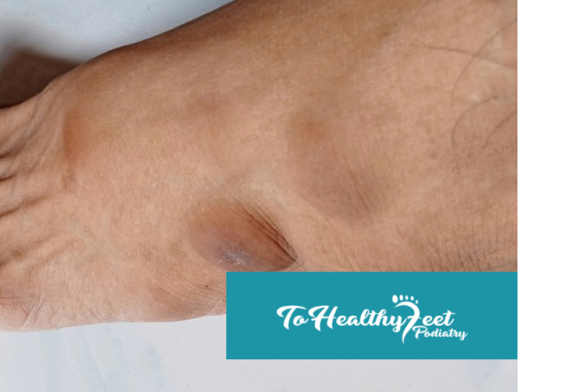Morton’s Neuroma and Footwear: What Shoes Could Be Making Your Pain Worse