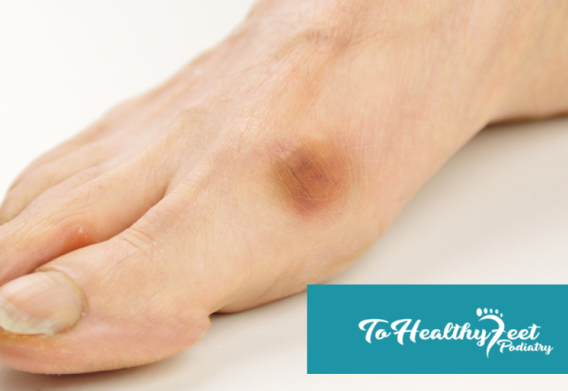 Conservative vs. Minimally Invasive Treatments for Morton’s Neuroma: What Works Best?