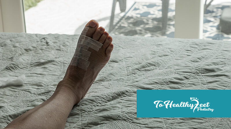 Tips To Survive Winter Bunion Surgery