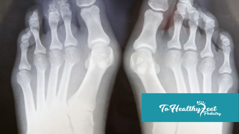 Bunion Management for NYC Marathon Runners