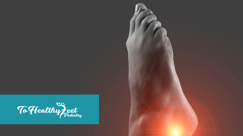 What Is Tarsal Tunnel Syndrome? An NYC Guide to Nerve Compression in the Foot