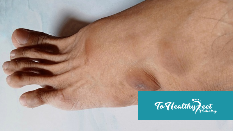 Morton’s Neuroma and Footwear: What Shoes Could Be Making Your Pain Worse