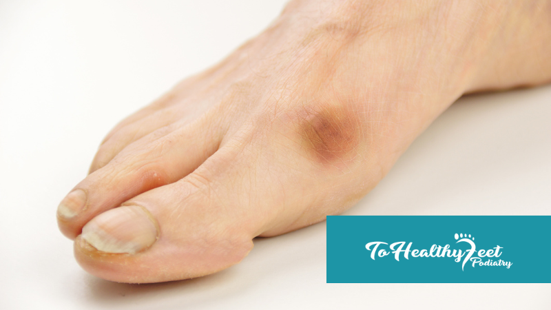 Conservative vs. Minimally Invasive Treatments for Morton’s Neuroma: What Works Best?